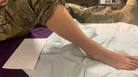 Image result for Ankle Injection Procedure