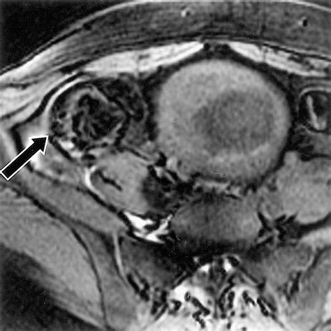 Ovarian Teratomas: Tumor Types and Imaging Characteristics | RadioGraphics