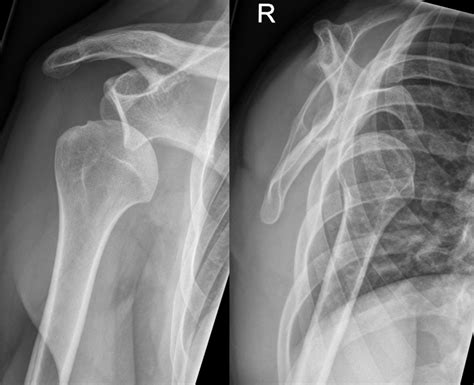Image result for Posterior Shoulder Dislocation Sulcus Sign