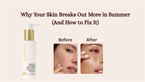 Why Your Skin Breaks Out More in Summer (And How to Fix It) – Perenne ...