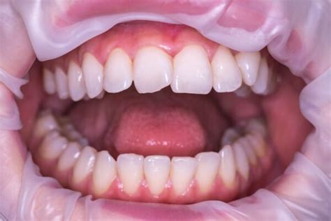 Ceramic Teeth