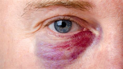 Corneal Abrasion: Scratched Eye Symptoms & Treatment