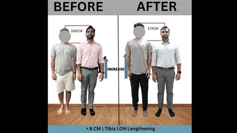 Limb Lengthening made easy – Height Increase Info provides an effective ...