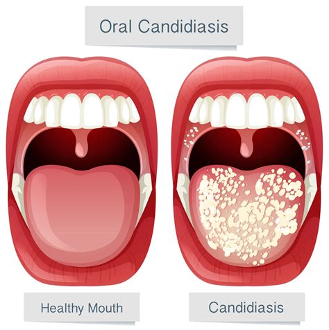 How to Treat Lingering Oral Thrush OTC & Medications