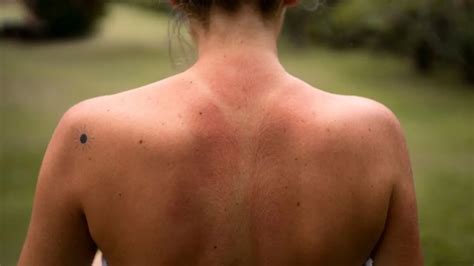 கோடையில் வியர்வை, தூசி காரணமாக ஏற்படும் பூஞ்சை தொற்றை தடுக்க உதவும் ...