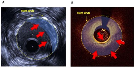 In Stent Neo-Atherosclerosis: Pathophysiology, Clinical Implications ...