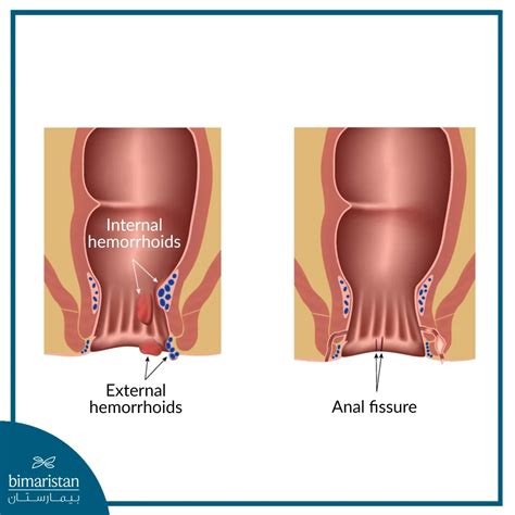 Anal Fissure: Main Causes and Treatment Methods - Bimaristan