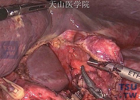 【图】完全腹腔镜下胃癌根治术 - 外科手术学 - 天山医学院