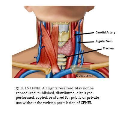 Image result for Postural Strangulation