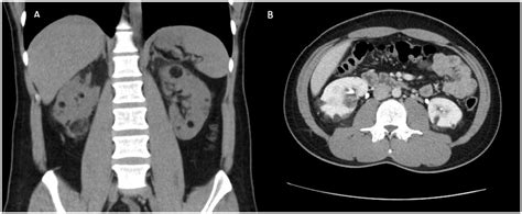 Tuberous Sclerosis Kidney