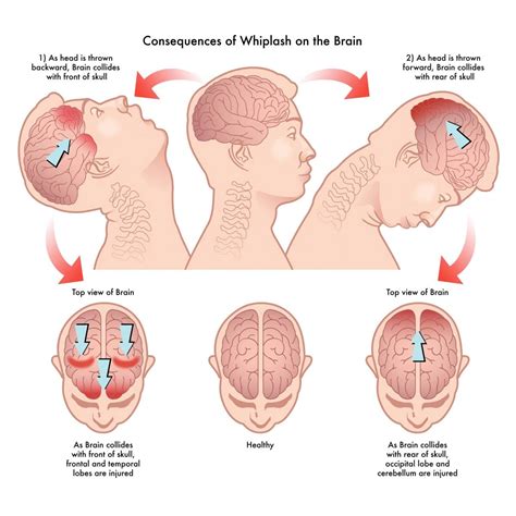 Spotting Whiplash Nerve Damage Symptoms Early