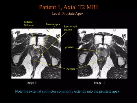 Prostate MRI anatomy from UNIVERSITY OF MICHIGAN | PPTX