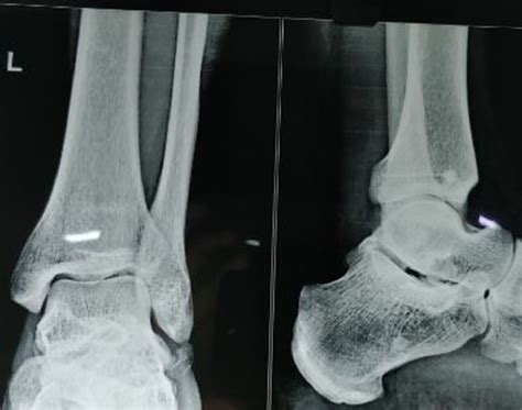Osteochondritis Dissecans of the Lateral Process of Talus Involving the ...