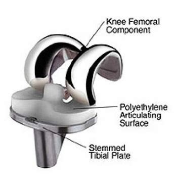 Patellar component/ Knee cap