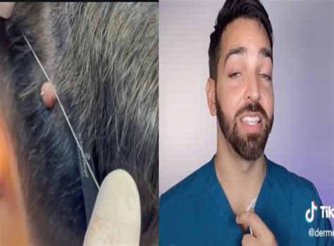 People Are Removing Their Own Moles Due To A TikTok trend