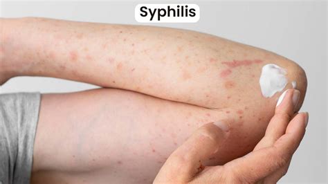 मंकीपॉक्स और स्किन इंफेक्शन की वजह से होने वाले रैशेज में अंतर ...