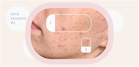 Clogged Pores On Chin