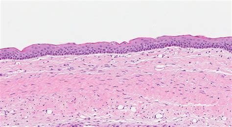 Histologia Do Tumor Odontogenico Ceratocistico Histology Of An