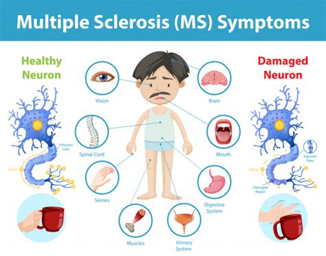 Early signs of multiple sclerosis (MS) UPSC