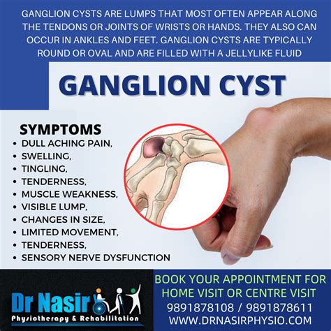Should I Pop My Ganglion Cyst at Janice Bowen blog