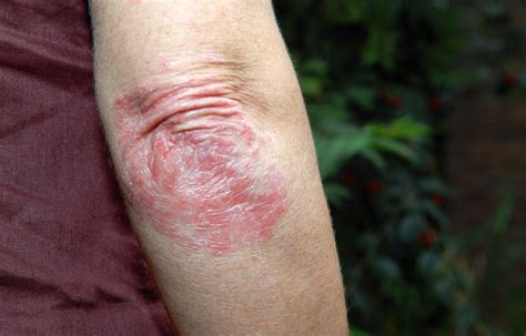FDA approves new oral treatment Sotyktu for psoriasis