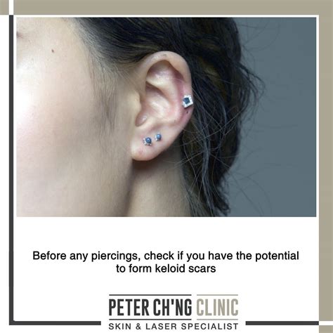 4 Steps to Prevent a Keloid Scar Formation | Peter Ch'ng Skin Specialist - KL, Malaysia