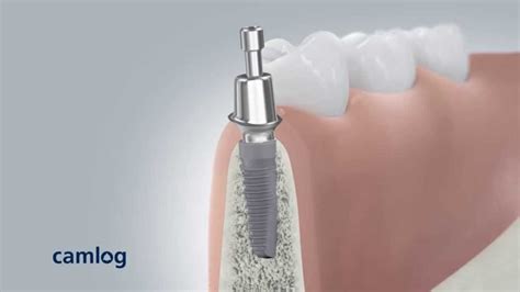 CAMLOG Dental Implant Insertion – 3D Video