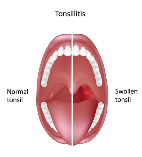 Normal Tonsils Picture A Man With An Open Mouth At The Doctor Shows