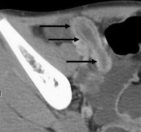 Ruptured Appendix X Ray