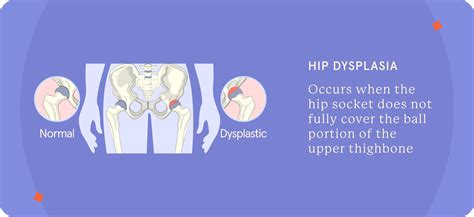 Hip Pain In Young Women: All You Need to Know | Fluent Health