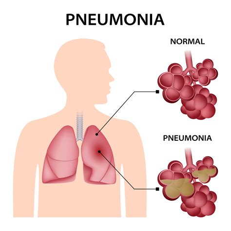 Early Signs of Pneumonia in Children | Doctor's Guide