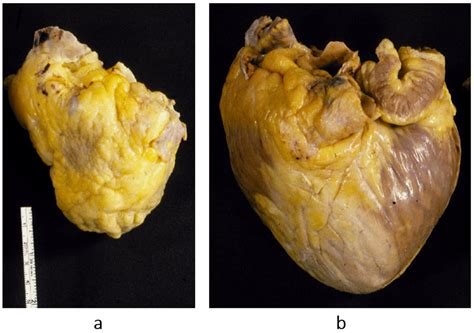 Cardiomyopathies: Temporal Review and Genetic Determination
