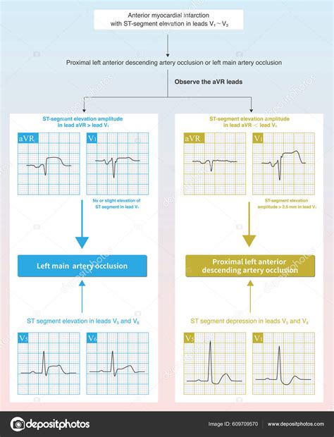 Case Acute Anterior Myocardial Infarction Characteristics Segment ...