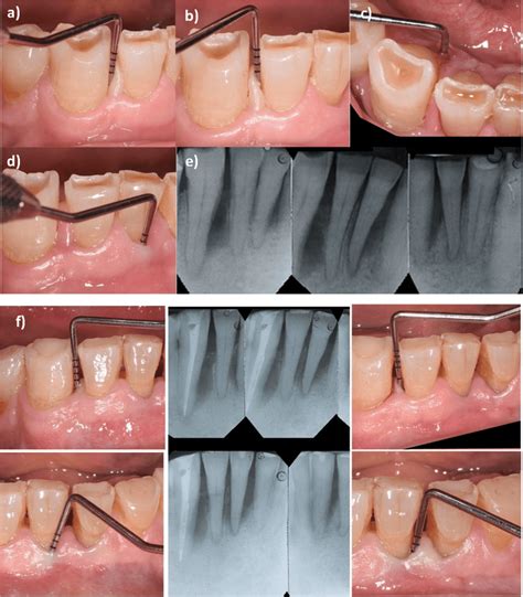 Classifications and Management of Endodontic-periodontal Lesions | Pocket Dentistry