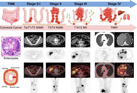 Frontiers | Tailoring the clinical management of colorectal cancer by ...