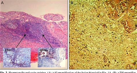 Subconjunctival Injection 的图像结果