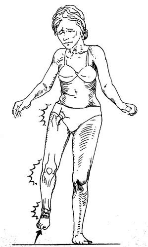 Image result for Contralateral Gait