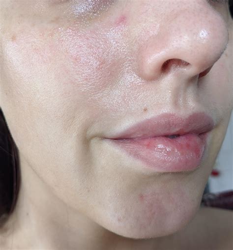 Red Bumps On Face