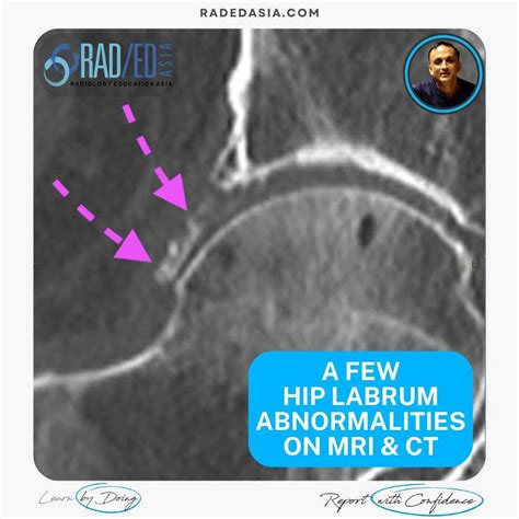HIP LABRUM ABNORMALITIES ON MRI & CT