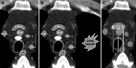 Cross-Disciplinary Analysis of Lymph Node Classification in Lung Cancer on CT Scanning - CHEST