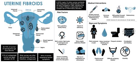 Uterine Fibroids: A Holistic Approach — Nutrunity⎪Naturopathic Clinic ⎪London | Expert Nutrition ...
