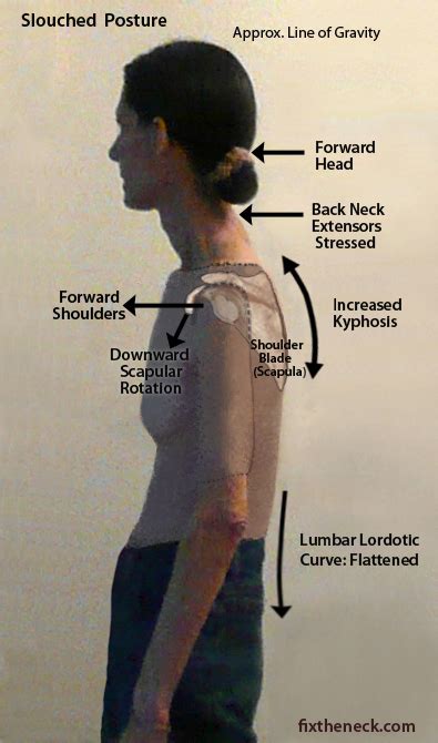 Overcoming Chronic Neck Pain: Postural Causes and A Unique Exercise Fix ...
