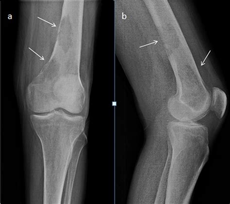 Osteosarcoma X Ray