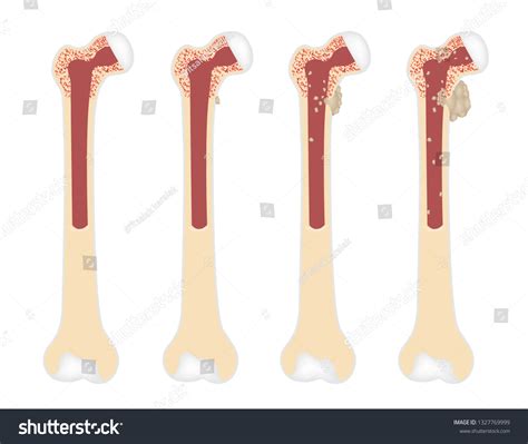 Stage 4 Bone Cancer