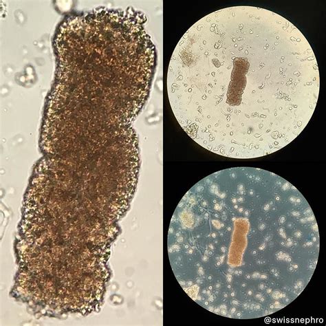 Urinalysis Granular Casts at Royce Denny blog