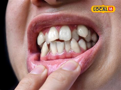 Dental Care: మీకు వంకర దంతాలు ఉన్నాయా.. ఇప్పుడే జాగ్రత్తగా పడండి! 'ఈ ...