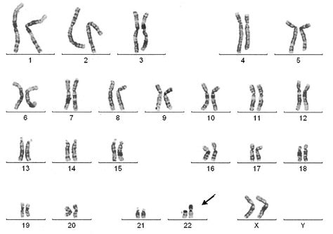 Xxy Chromosome In Females Klinefelter (XXY) & Turner Syndrome (Gonadal