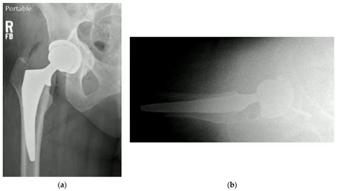 Managing Native Hip Protrusio: Simplified Classification and Surgical Recommendations