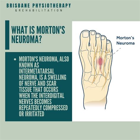 What is Morton's Neuroma? - Brisbane Physiotherapy & Podiatry