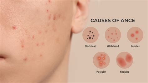 5 Types Of Acne You Should Know About | Causes of Acne | Acne Fighter ...
